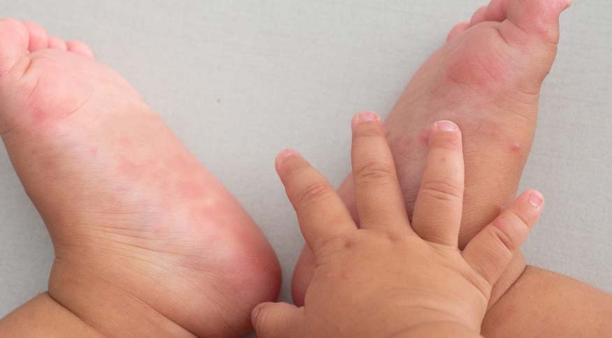Dr. Yeung Ho Hong(楊浩康) explains Hand, Foot, and Mouth Disease
