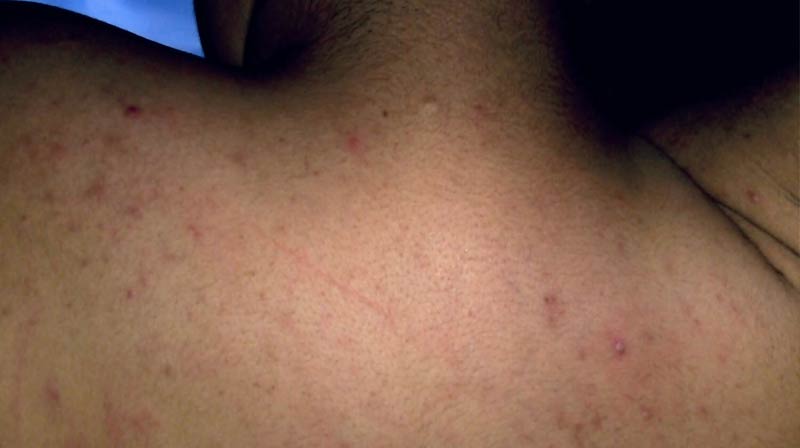 Dr. Yeung Ho Hong(楊浩康) explains Heat Rash