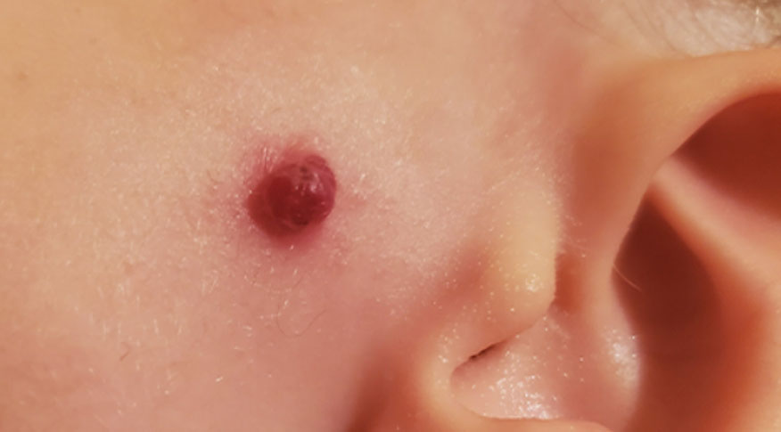 Dr. Yeung Ho Hong(楊浩康) explains Pyogenic Granuloma